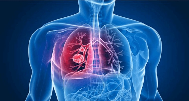 Majunga est une région à haute prévalence de la tuberculose